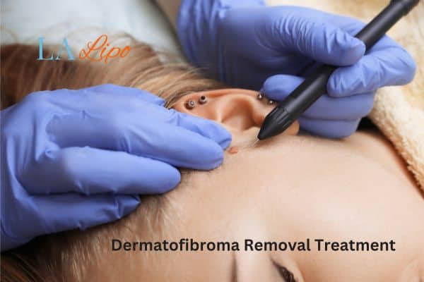 Dermatofibroma Removal Treatment Isleworth