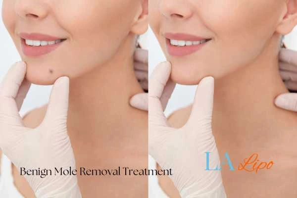 Before-and-after results following benign mole-removal treatment Isleworth