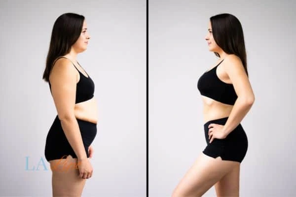 image of woman before and after results of LA-EMS Body Sculpting Isleworth to help treat Diastasis recti