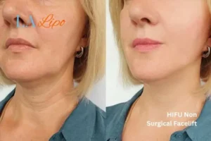 hi-fu for wrinkles Isleworth before and after results