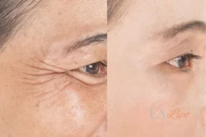 Before and after results of woman - HI-fu wrinkles reduction treatment Isleworth