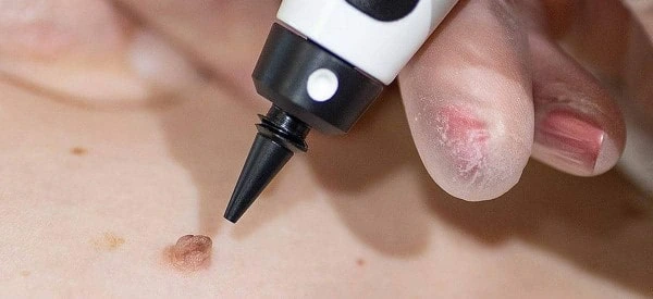 skin tag removal using cryopen Isleworth