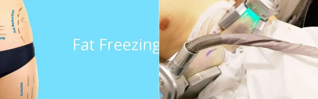 Fat freezing Isleworth on multiple areas of the body