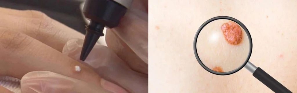 CryoPen practitioner Isleworth assessing a benign mole before treatment