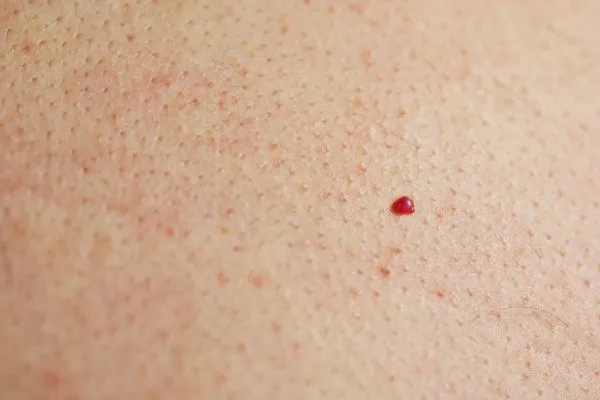 close up of a cherry angioma Isleworth