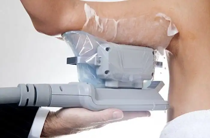 Picture of fat freezing Isleworth on the upper arms.