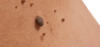 image of a skin tag Isleworth