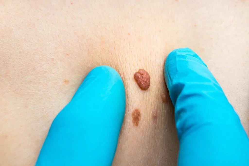 Consultant examining a skin tag Isleworth