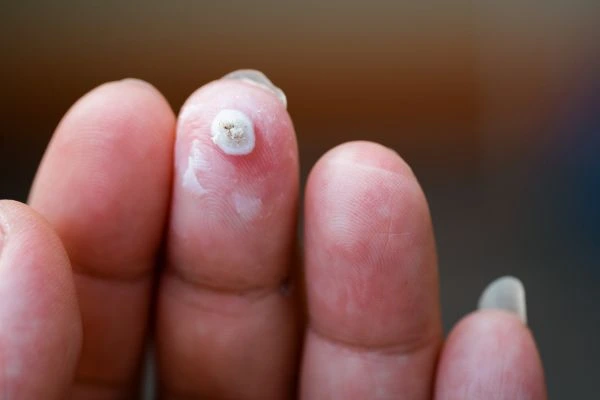 wart on person finger - cryotherapy to treat from LA LIPO Isleworth