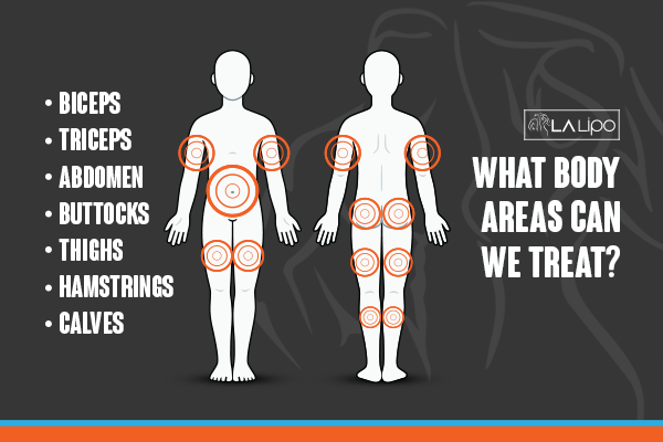 Diagram to show areas you can have LA-EMS Body Sculpting Treatment Isleworth