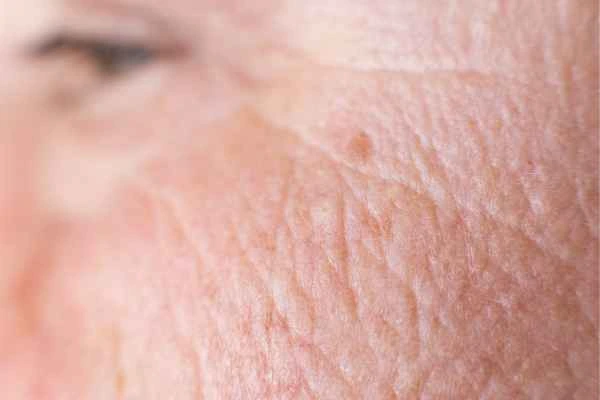 close up picture of a woman's face showing an age spot Isleworth