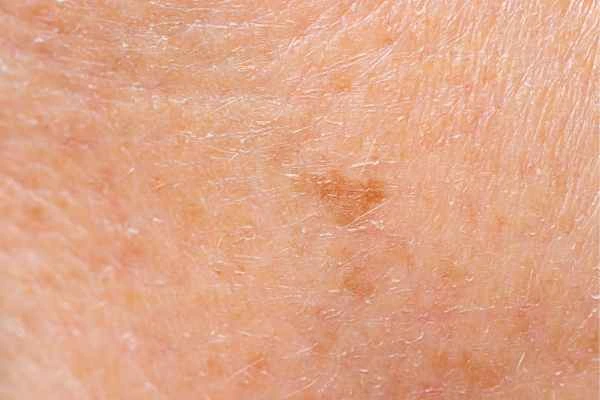 close up picture of age spots Isleworth