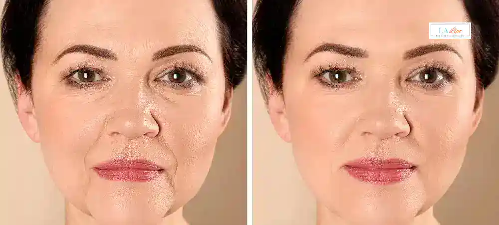 How Long Does It Take to See Results and How Long Do They Last Isleworth?