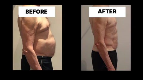 What Symptoms Can Diastasis Recti Cause in Men? Weak Core, Back Pain and Poor Posture Isleworth